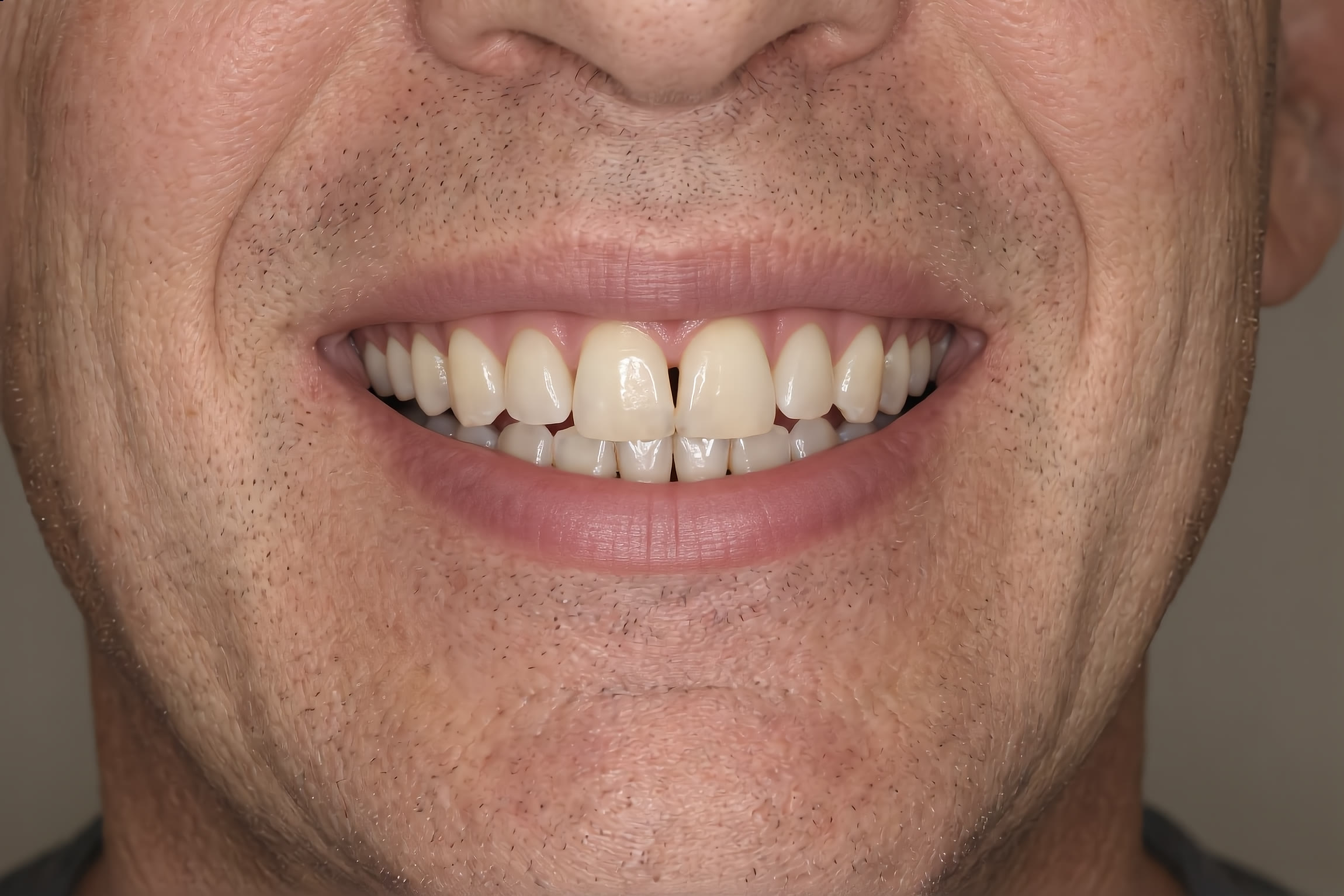 Case 301 after full-arch fixed implant bridge