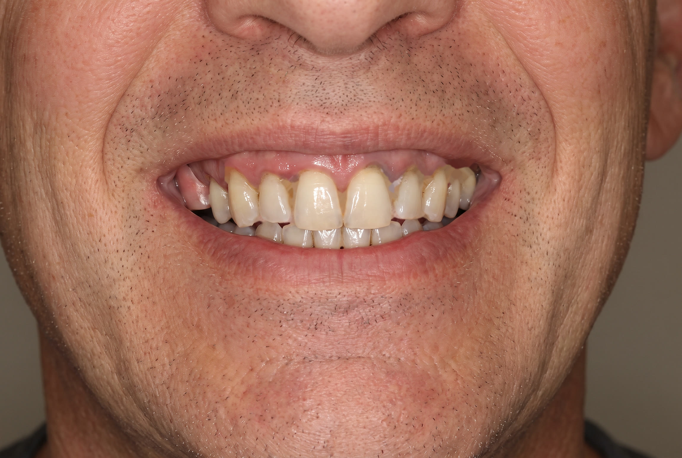 Case 301 before full-arch implant treatment